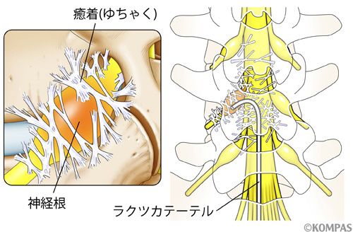 カテーテル外観（腰椎タイプ）