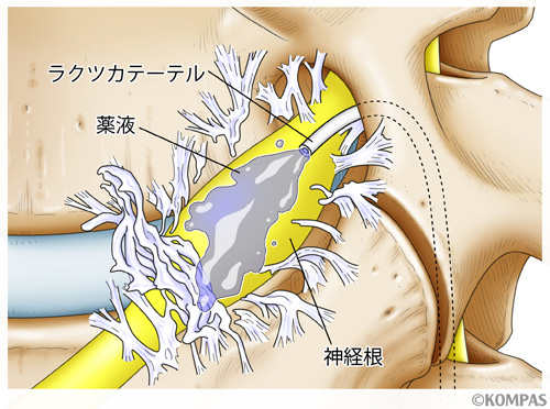 炎症を起こしている場所に直接薬剤を投与