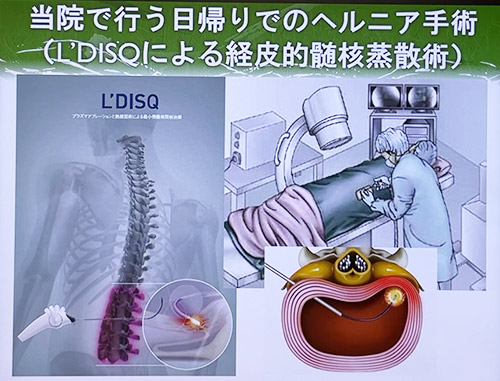 経皮的椎間板蒸散術
