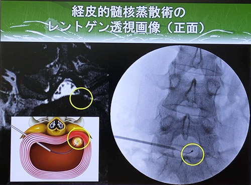 経皮的椎間板蒸散術